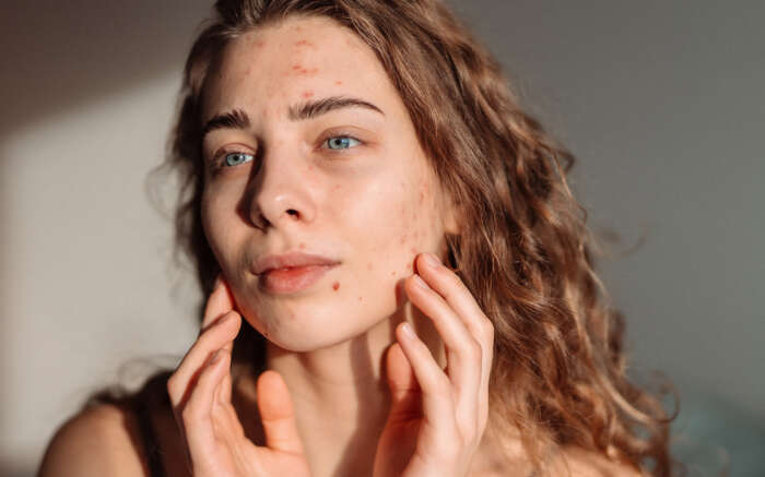 Junge Frau mit Ausschlag im Gesicht