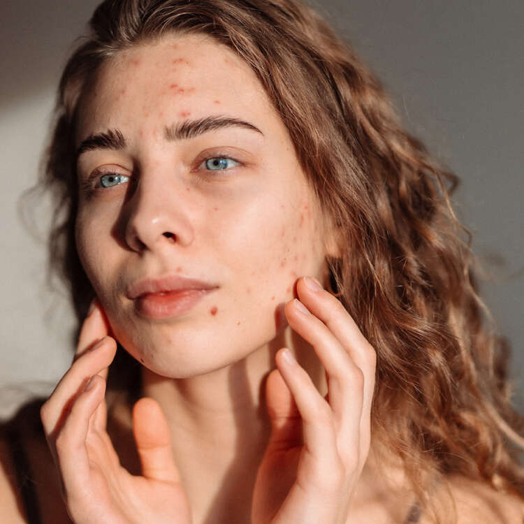 Junge Frau mit Ausschlag im Gesicht