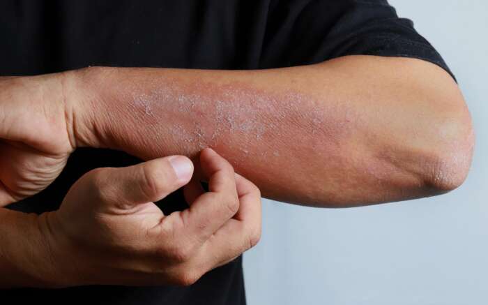 Ein starker Ausschlag am Unterarm, an dem gekratzt wird