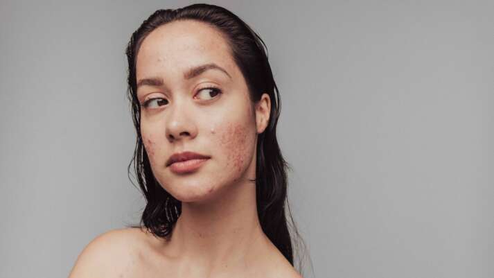Eine junge Frau mit Akne im Gesicht